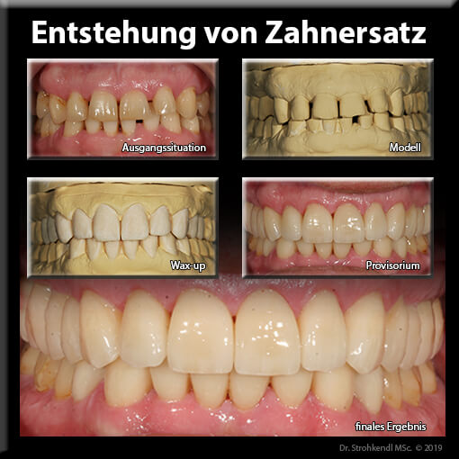 Entstehung von Zahnersatz Stuttgart