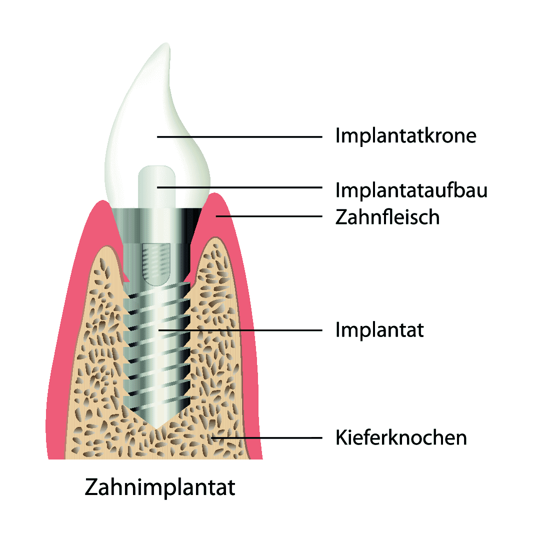 Zahnimplantat Stuttgart Aufbau Zahnimplantat Stuttgart Aufbau